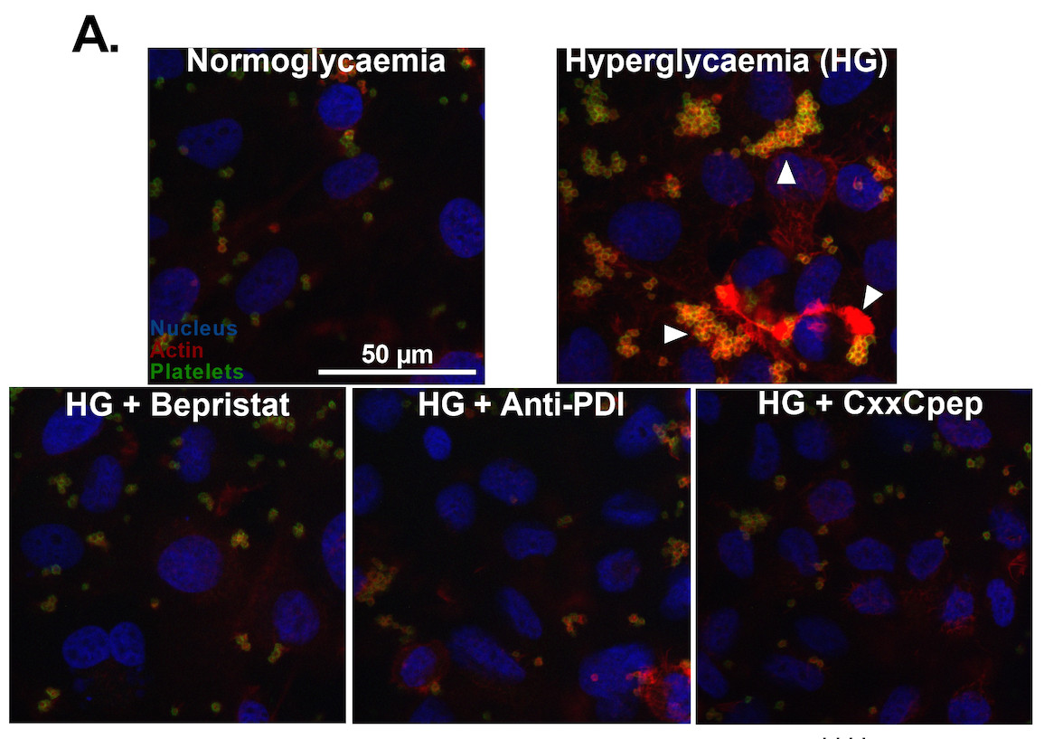 PecPDI inhibition abrogates the increased platelet adherence onto hyperglycemic human umbilical vein endothelial cells (HUVECs). Representative images of normoglycemic and hyperglycemic cells and hyperglycemic cells with PDI inhibitors. HUVECs were incubated with platelet-rich plasma isolated from healthy donors. Arrowheads indicate dense platelet aggregates.